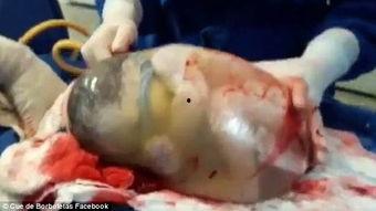 医生破羊水视频,医生捕捉珍贵瞬间