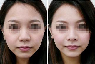 玻尿酸填充嘴唇视频,美丽蜕变，轻松实现