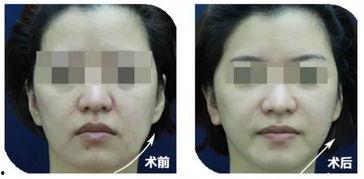 全脸线雕视频,面部年轻化的秘密武器