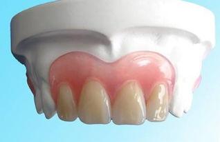 镶牙烤瓷牙视频全过程,从准备到完成